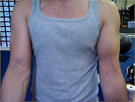 Distal Biceps Rupture